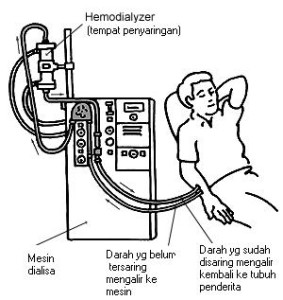 hemodialisa
